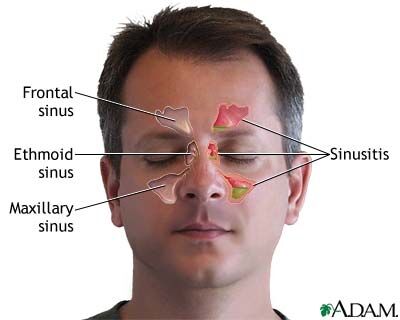 Successful Endoscopic Removal of a Large Nasal Polyp in a Chronic Sinusitis Patient